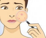 Natuurlijke preventie van acne veiliger dan Roaccutane