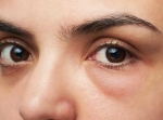 Oorzaken van gezwollen oogleden