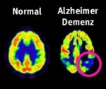 Pfizer stopt onderzoek naar alzheimermedicijn