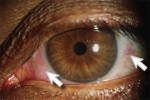 Essentiële vetzuren tegen droge ogen.